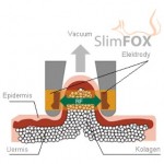 Schema ultrazvukové sondy pro kavitaci (SlimFox)