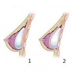Umístění implantátu v prsu